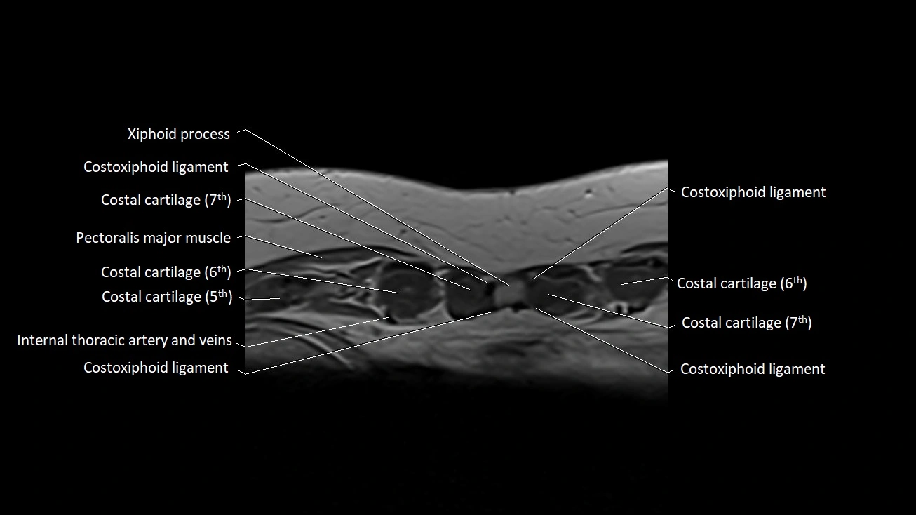 MRI sternum and sternoclavicular joint labeled axial anatomy image 35.webp